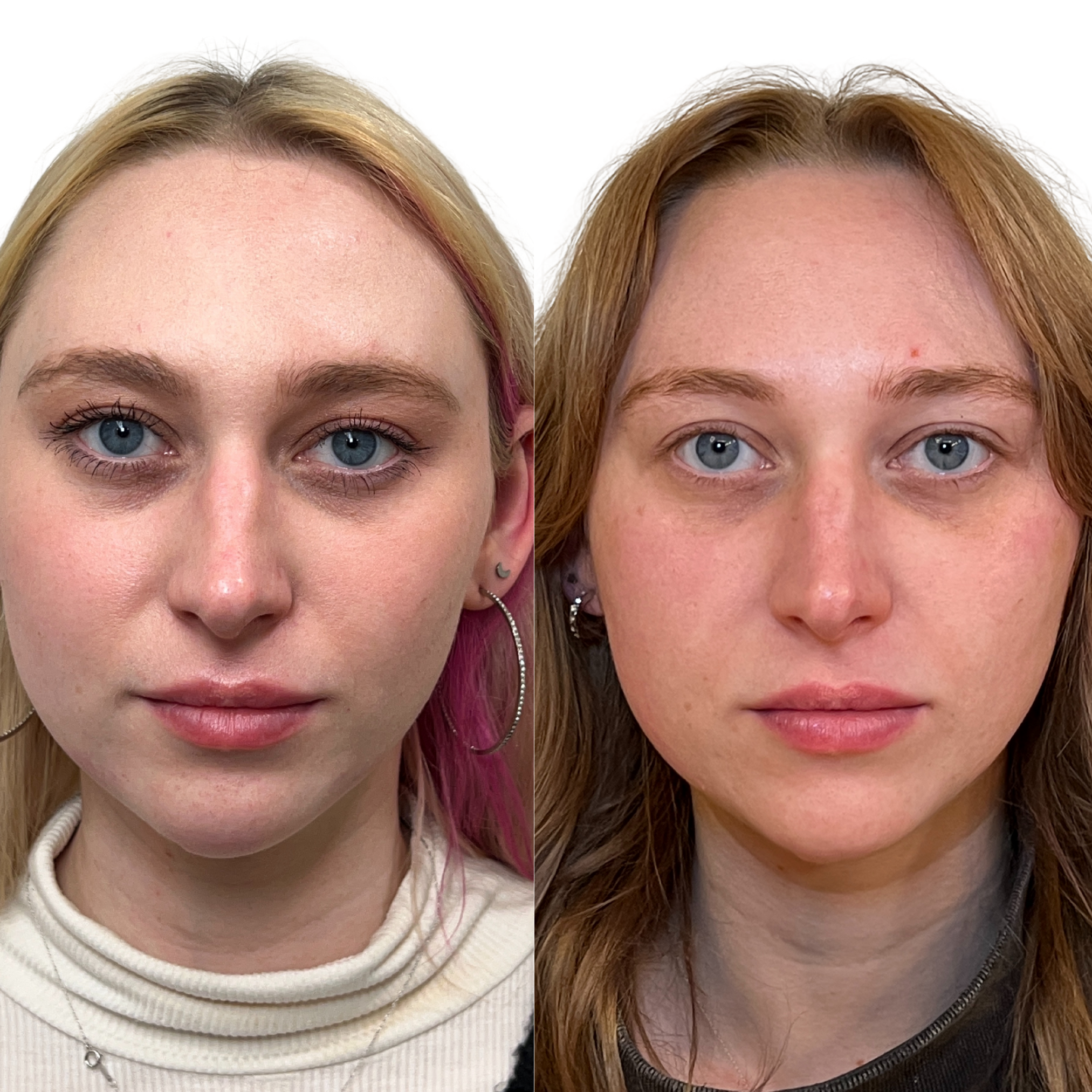 SkinFix: Microneedling + PRF – Beauty Fix MedSpa