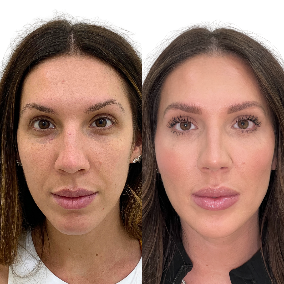 FaceFix: Salmon DNA – Beauty Fix MedSpa