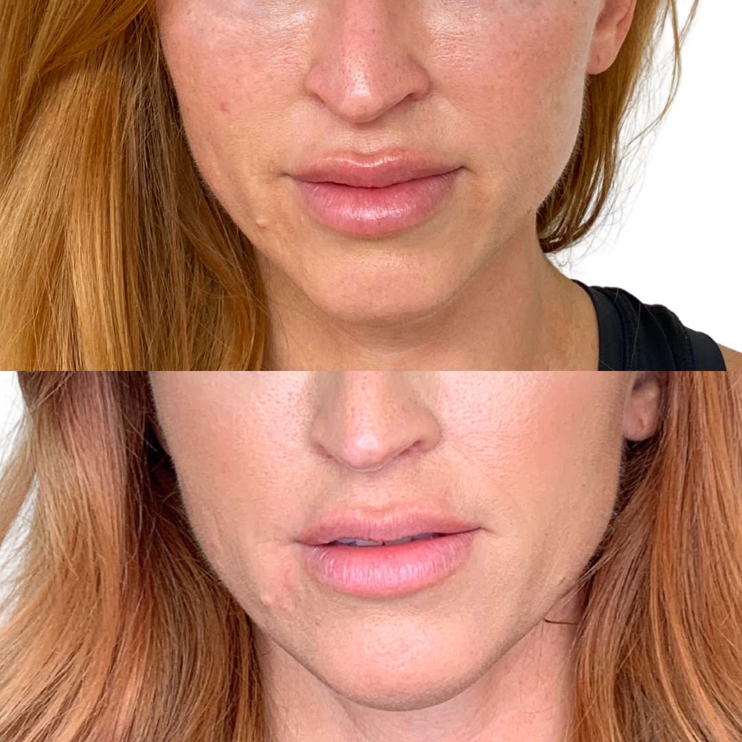 ReverseFix: Filler Dissolver – Beauty Fix MedSpa