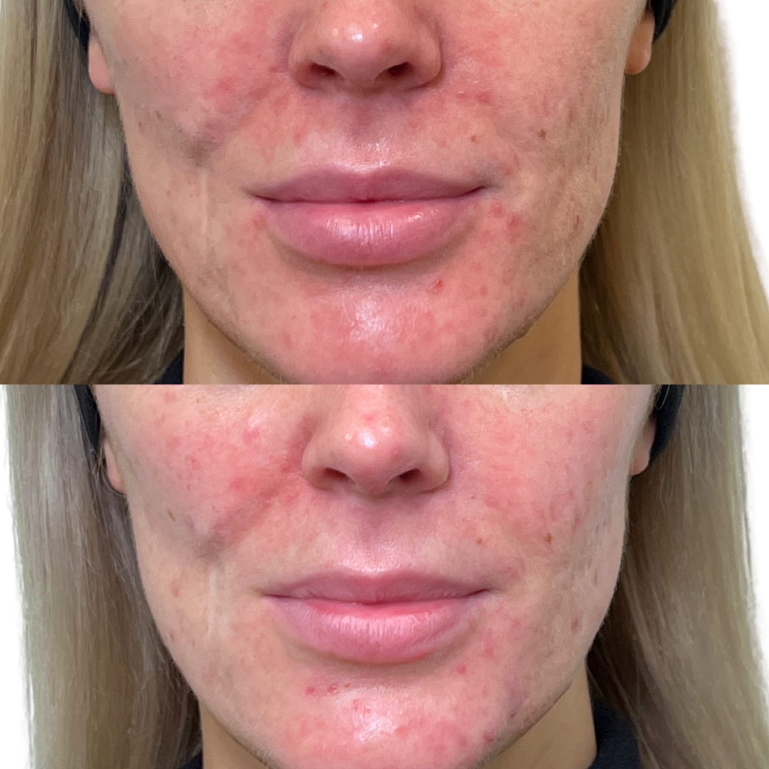 ReverseFix: Filler Dissolver – Beauty Fix MedSpa