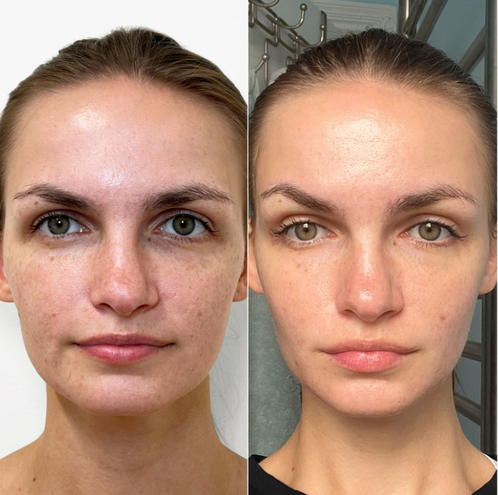 SkinFix: VI Peel – Beauty Fix MedSpa