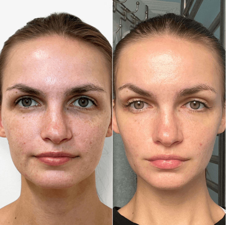 SkinFix: Vi Peel | BeautyFix MedSpa - (212) 366-4787
