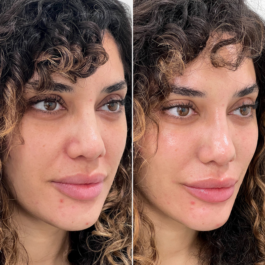 SkinFix: Hydrafacial – Beauty Fix MedSpa