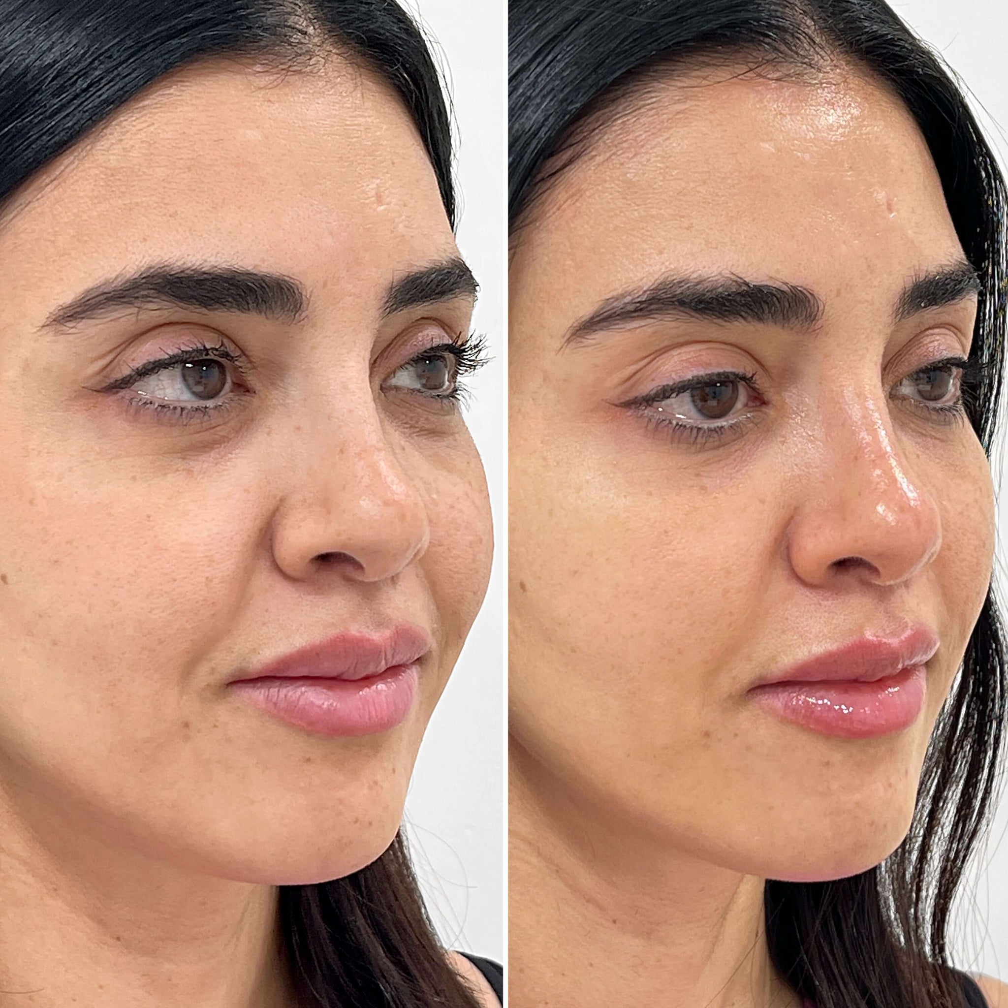 SkinFix: Hydrafacial – Beauty Fix MedSpa