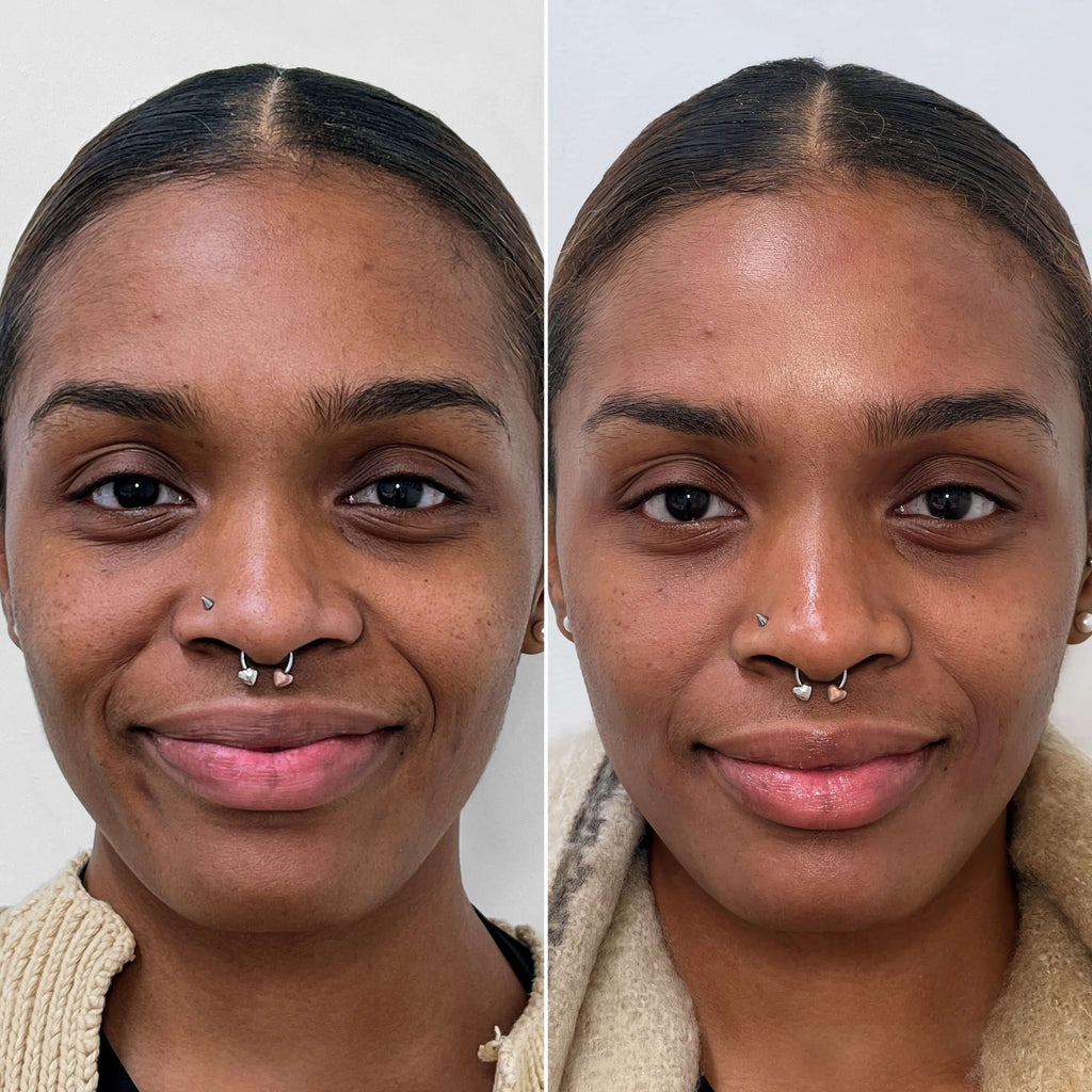 SkinFix: Hydrafacial – Beauty Fix MedSpa