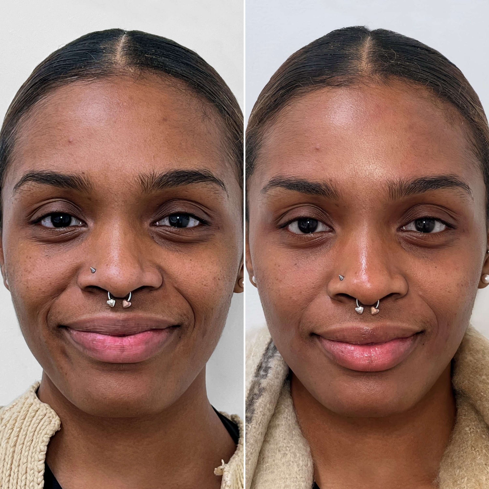 SkinFix: Hydrafacial – Beauty Fix MedSpa