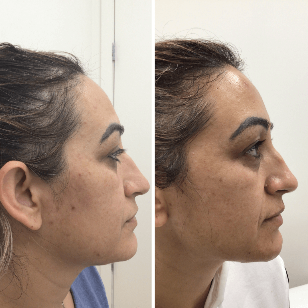 SkinFix: Hydrafacial – Beauty Fix MedSpa