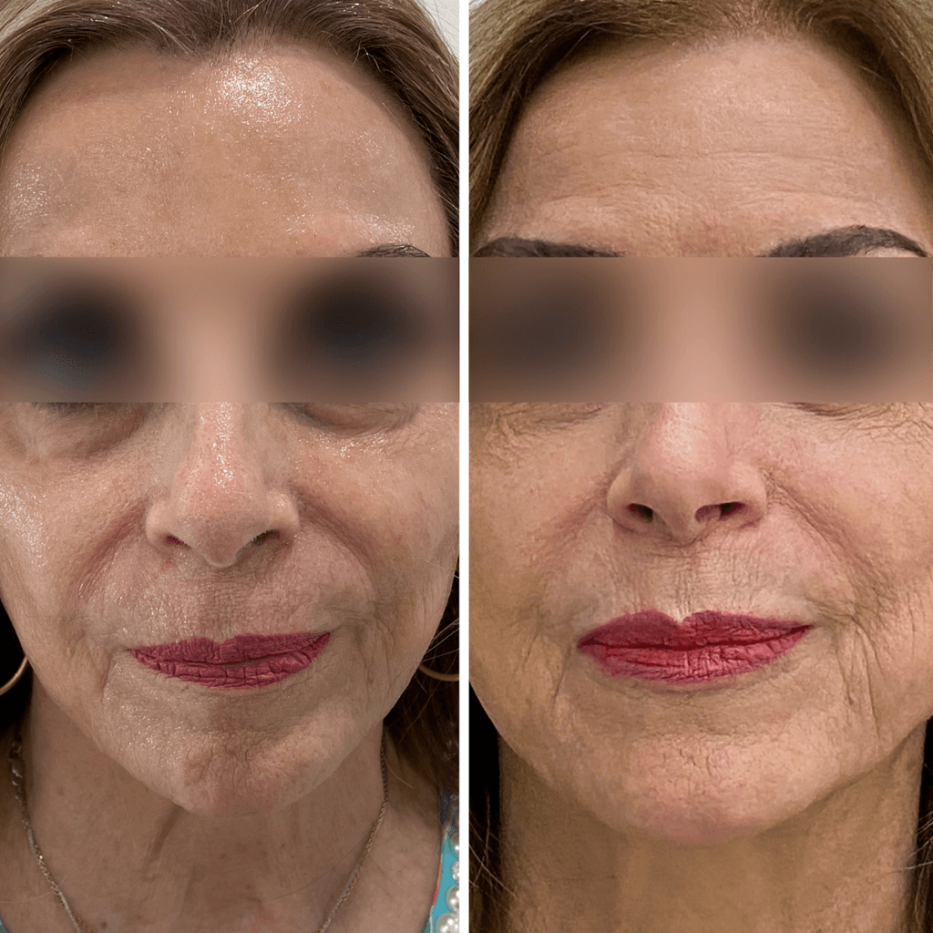 SkinFix: Microneedling – Beauty Fix MedSpa