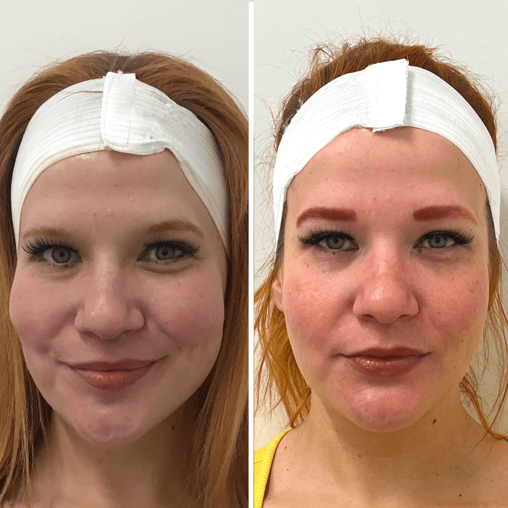 SkinFix: Microneedling + Plasma – Beauty Fix MedSpa