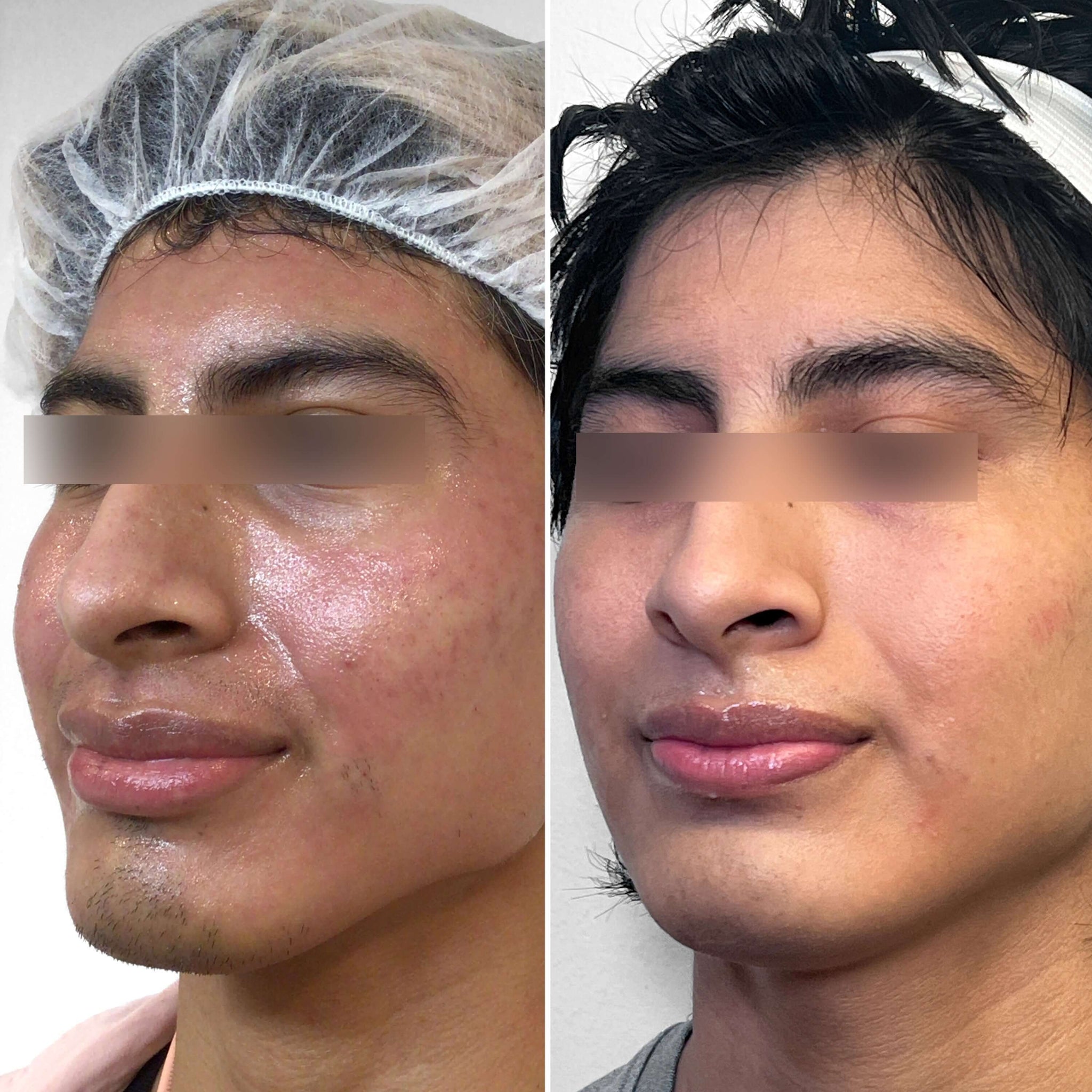 SkinFix: Morpheus8 – Beauty Fix MedSpa