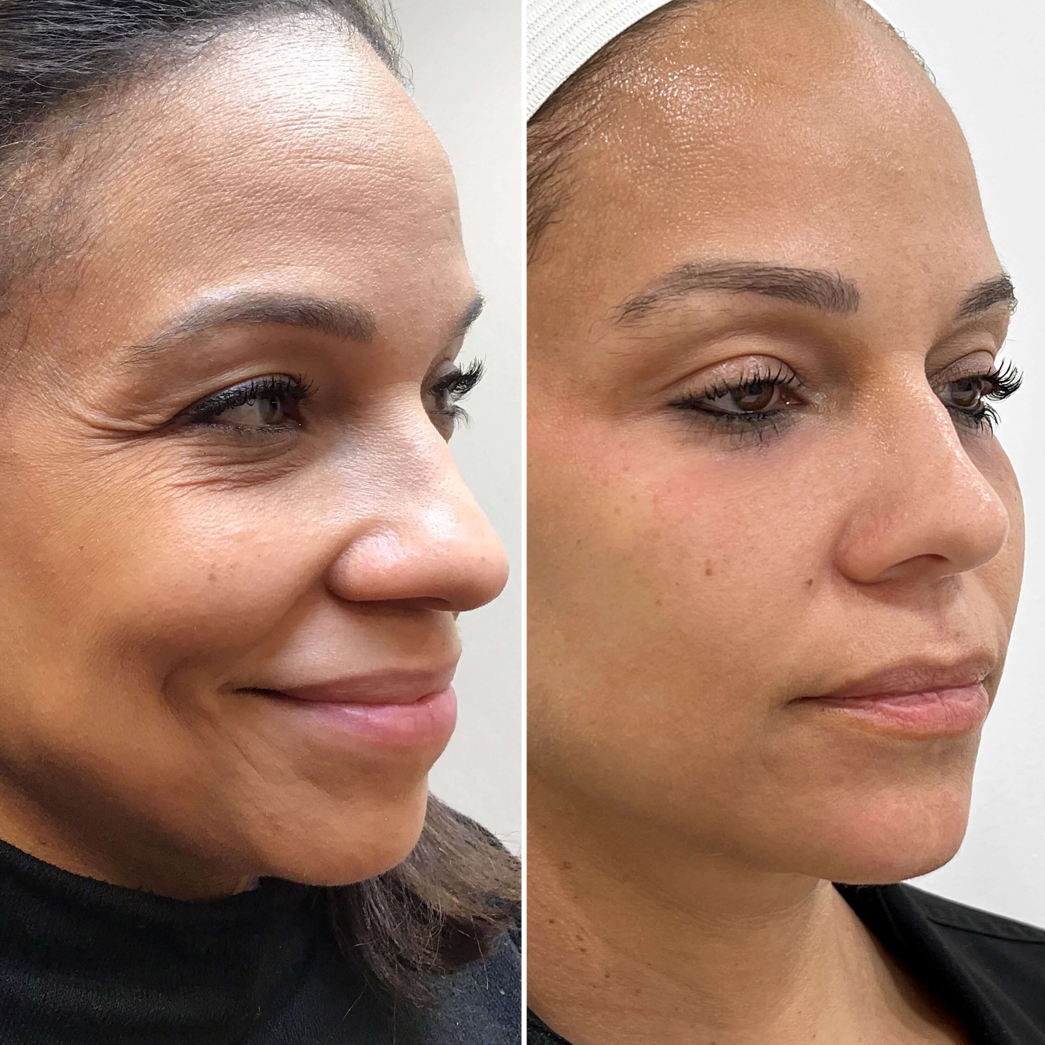 SkinFix: Morpheus8 – Beauty Fix MedSpa