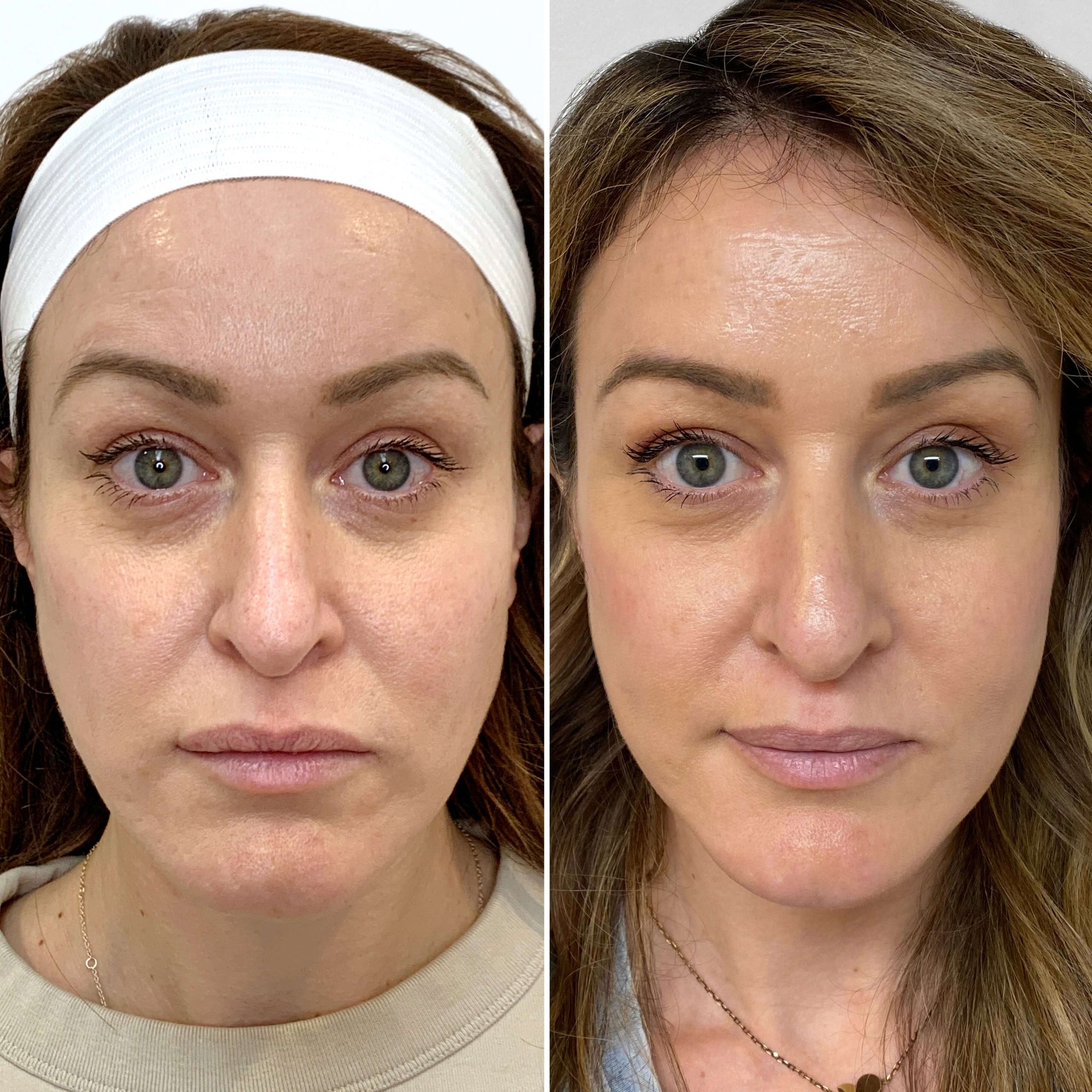 EyeFix: Morpheus8 – Beauty Fix MedSpa