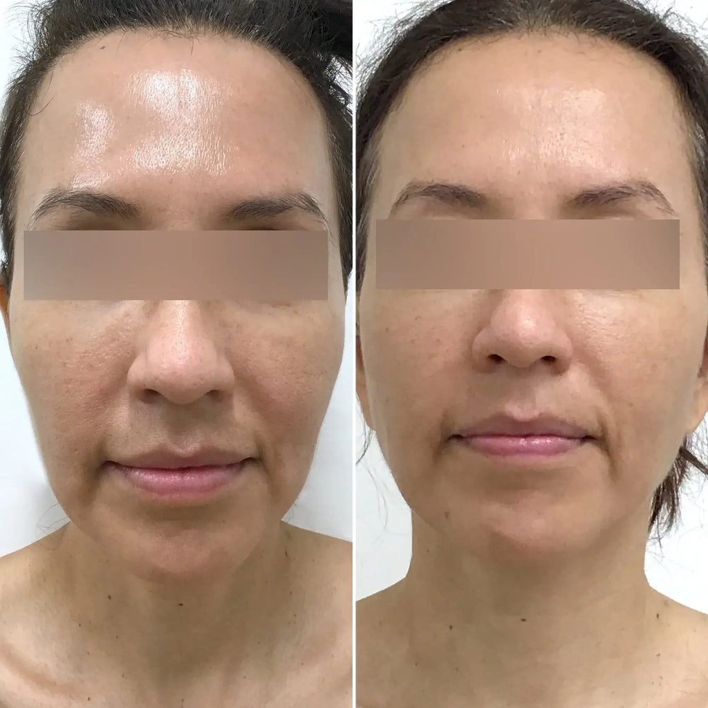 SkinFix: Morpheus8 – Beauty Fix MedSpa