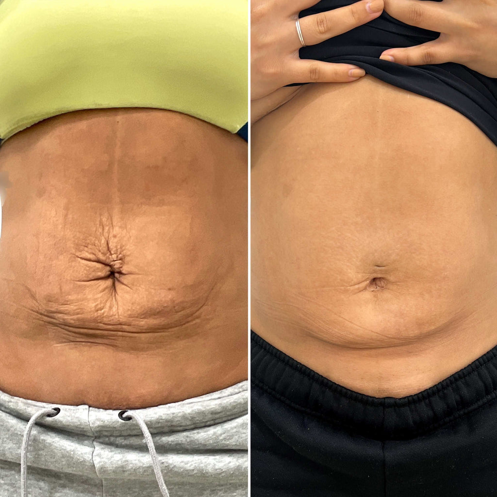 BodyFix: Morpheus8 – Beauty Fix MedSpa