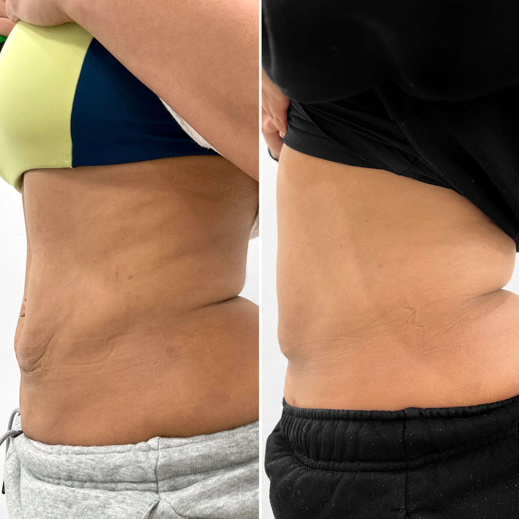 BodyFix: Morpheus8 – Beauty Fix MedSpa
