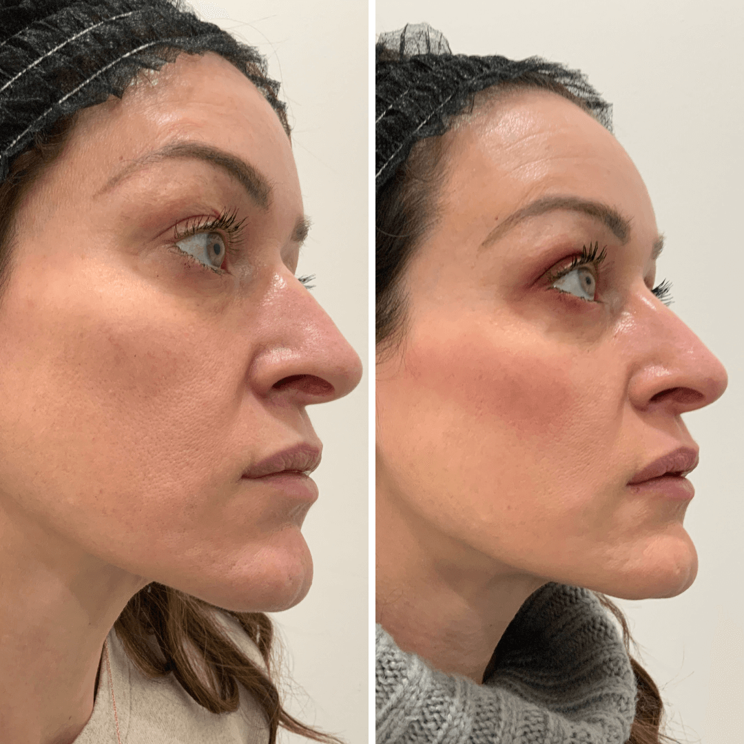 SkinFix: Sculpting Facial – Beauty Fix MedSpa