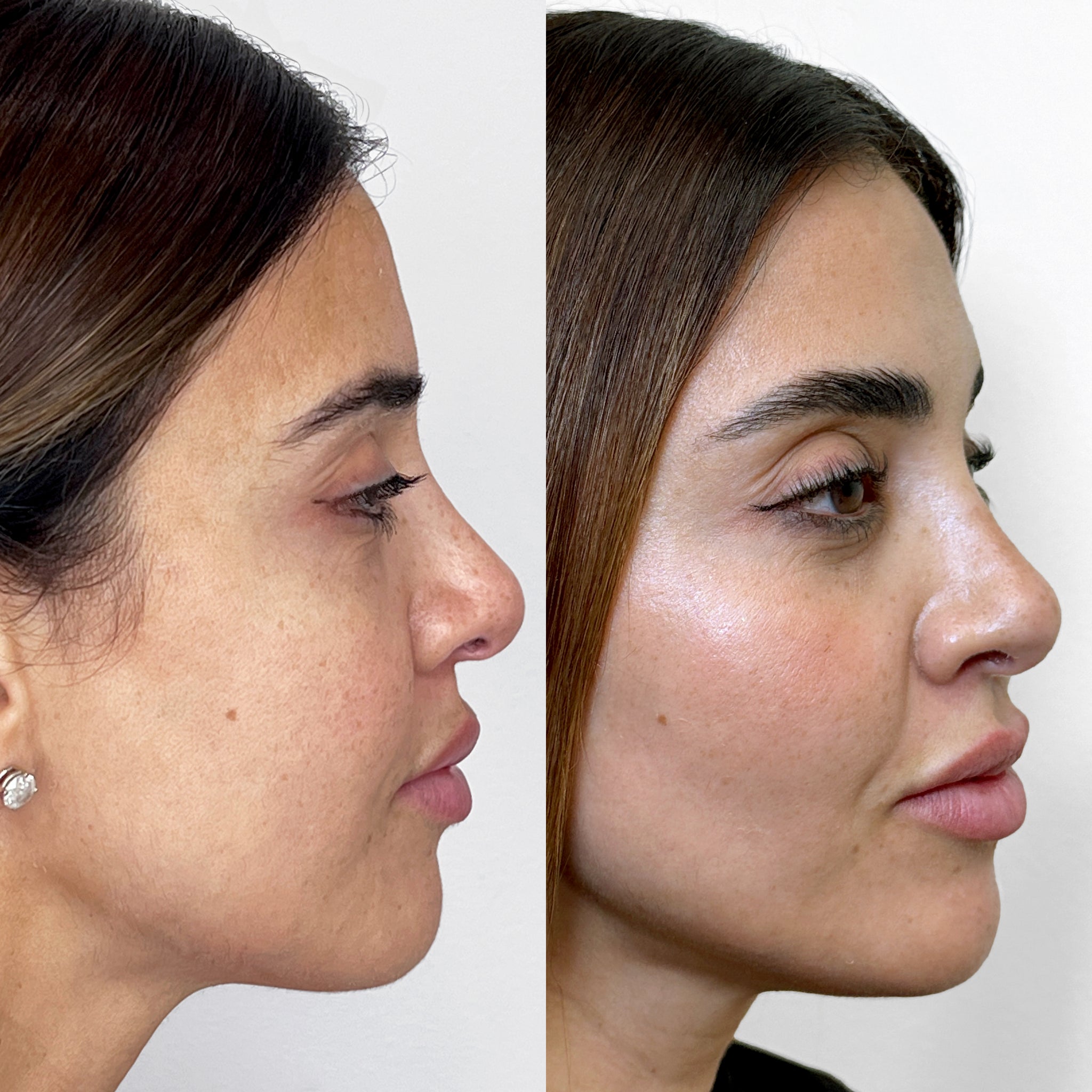 FaceFix: Salmon DNA – Beauty Fix MedSpa