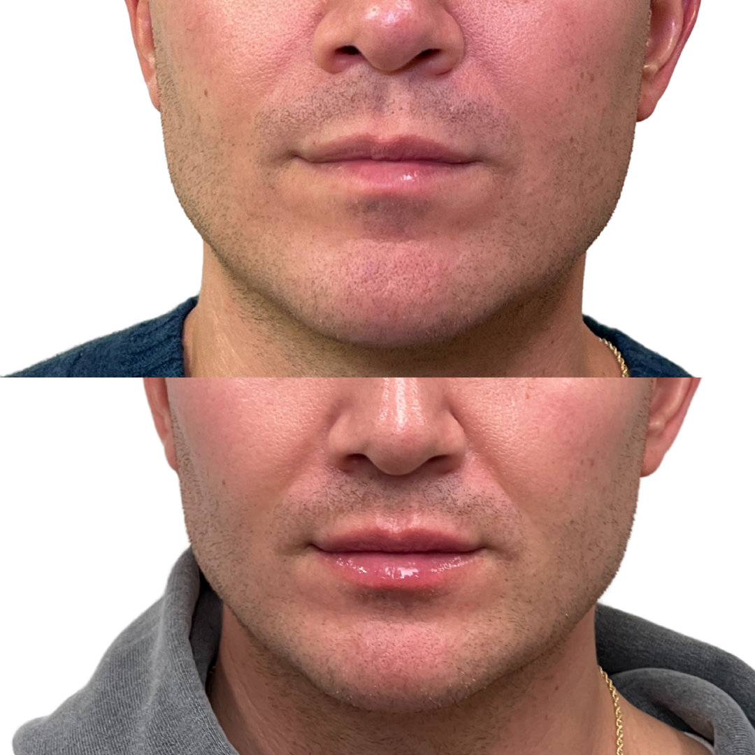 LipFix: Hydrate (SkinVive) – Beauty Fix MedSpa
