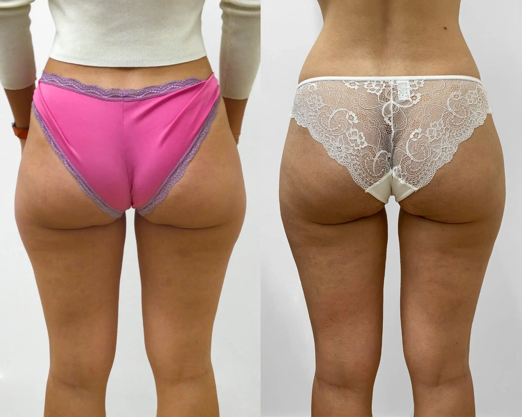 ThighFix: CoolSculpting – Beauty Fix MedSpa