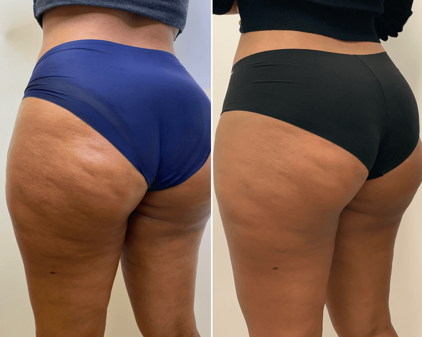 CelluliteFix: Venus – Beauty Fix MedSpa