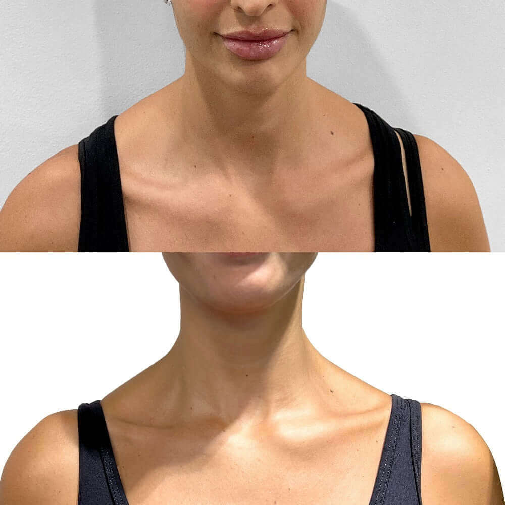 BodyFix: TrapTox – Beauty Fix MedSpa