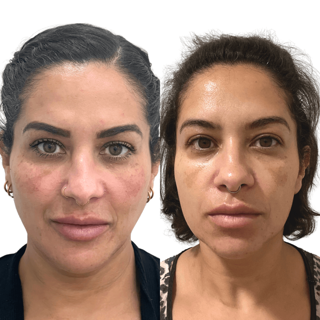 SkinFix: Vi Peel | BeautyFix MedSpa - (212) 366-4787
