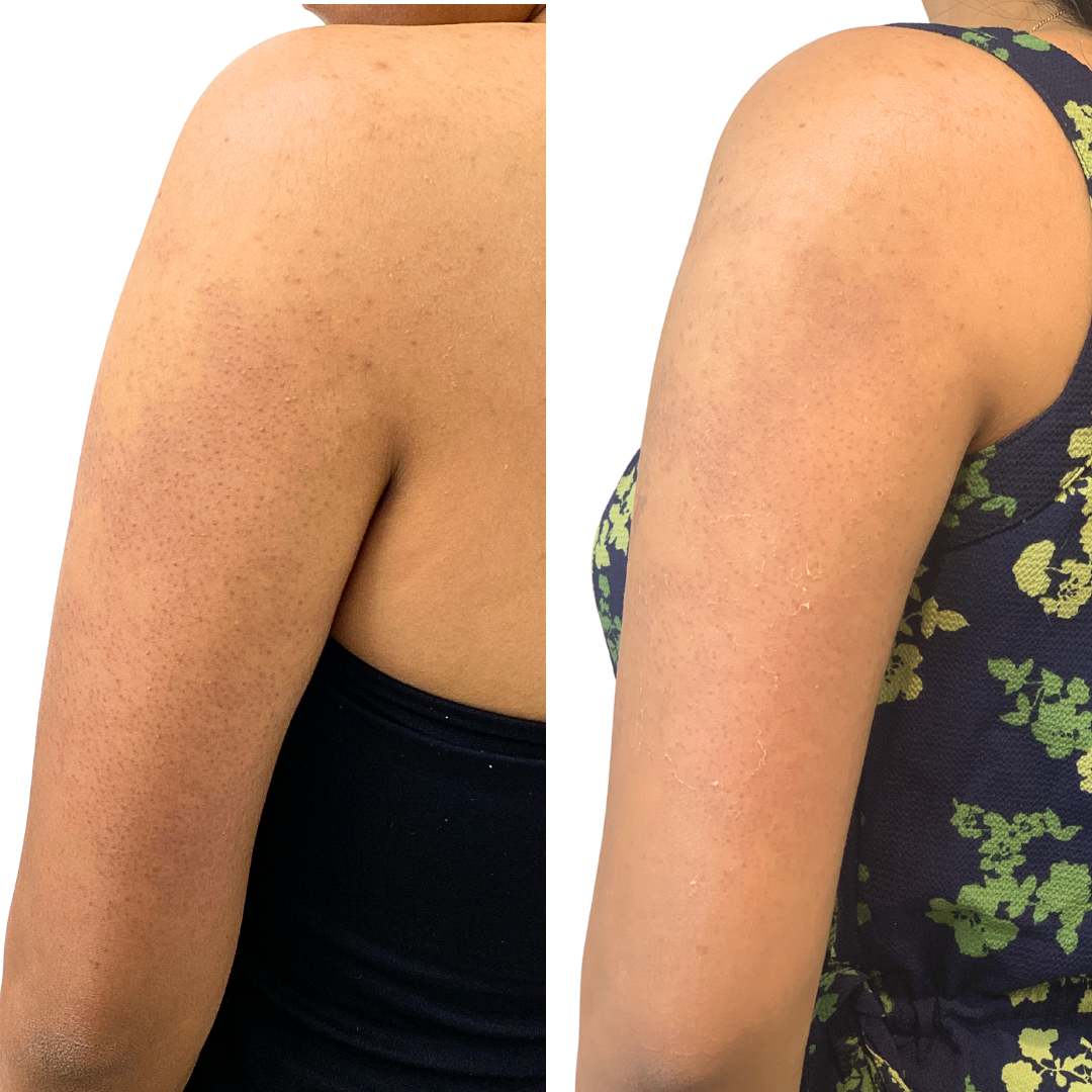 SkinFix: VI Peel – Beauty Fix MedSpa