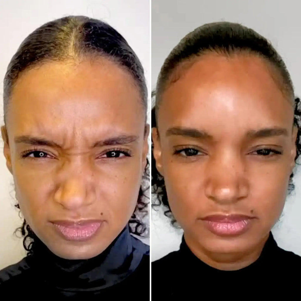 WrinkleFix: Unlimited Toxins Membership – Beauty Fix MedSpa
