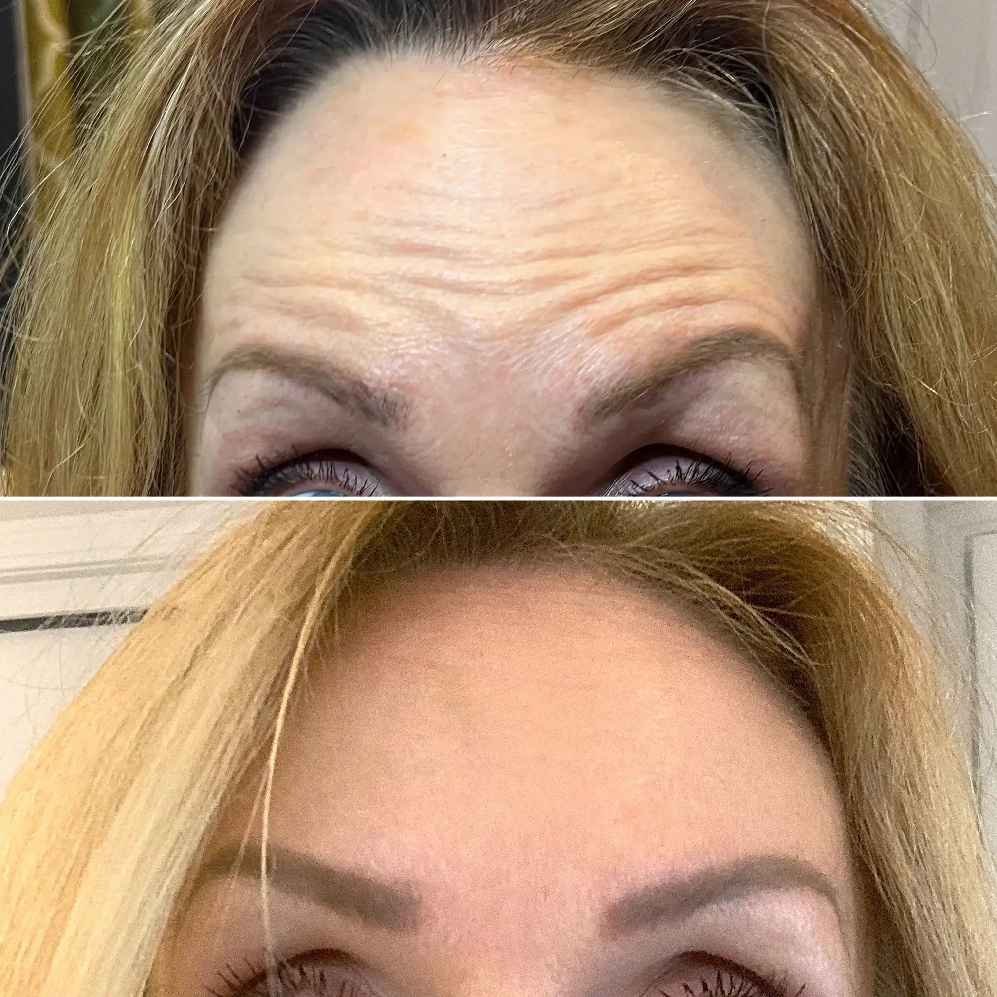 WrinkleFix: Daxxify™ – Beauty Fix MedSpa