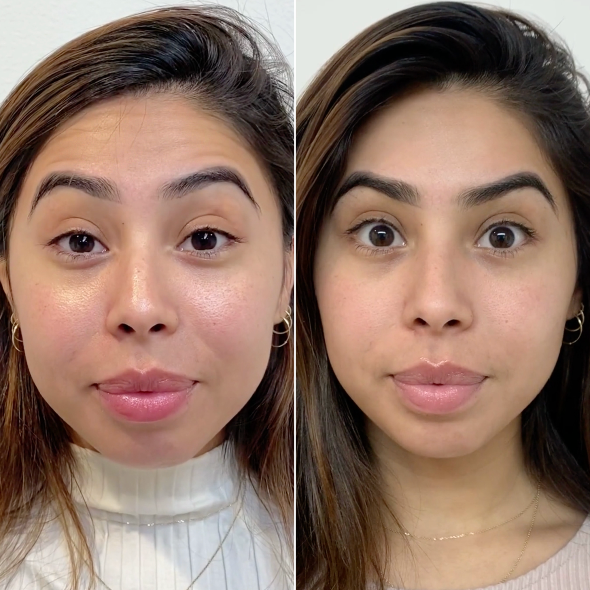 WrinkleFix: Unlimited Toxins Membership – Beauty Fix MedSpa