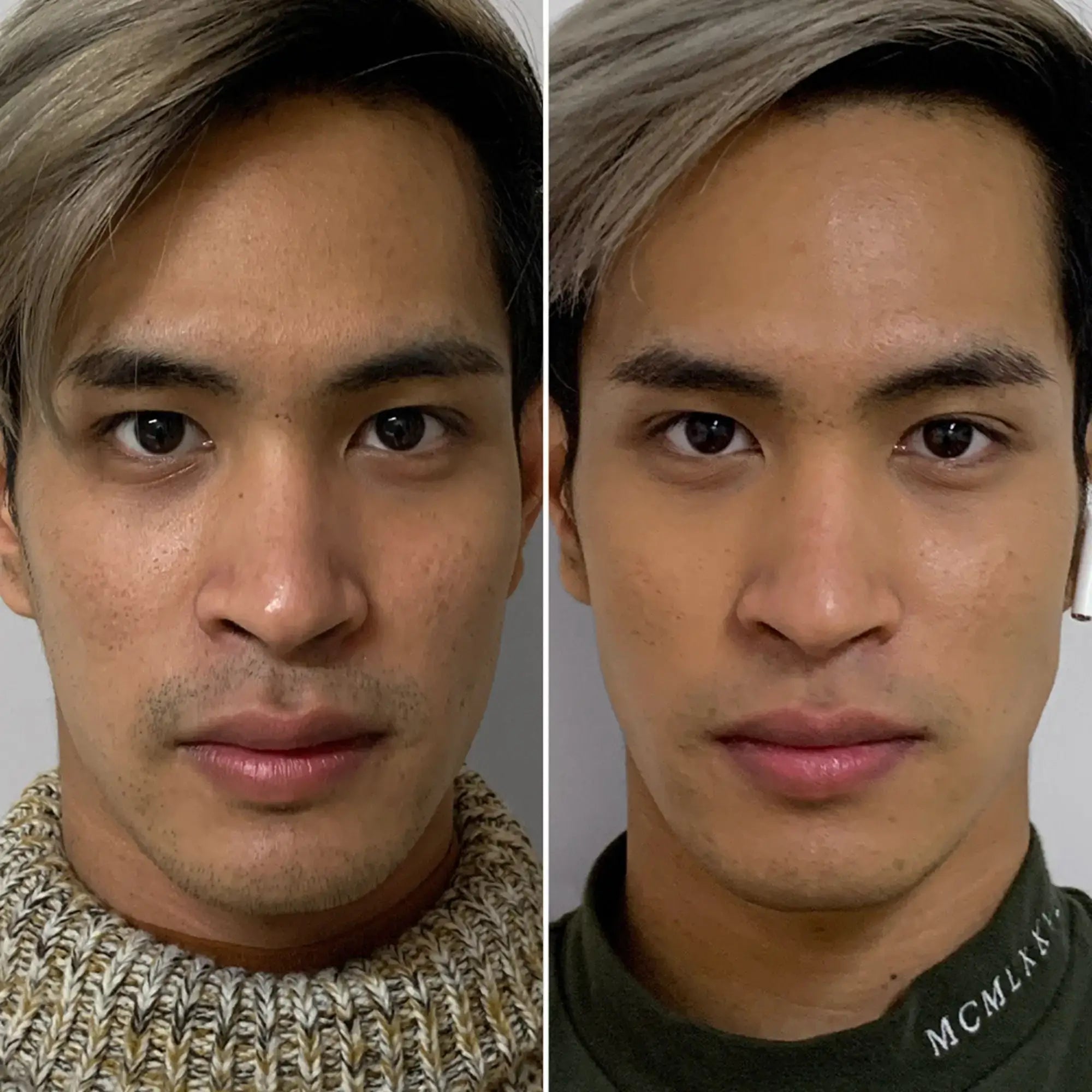 SkinFix: Resurfacing Facial – Beauty Fix MedSpa