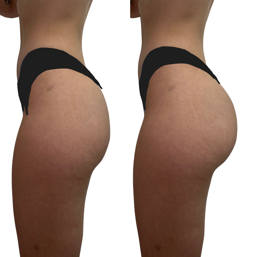 BootyFix: AlloClae™ Filler – Beauty Fix MedSpa