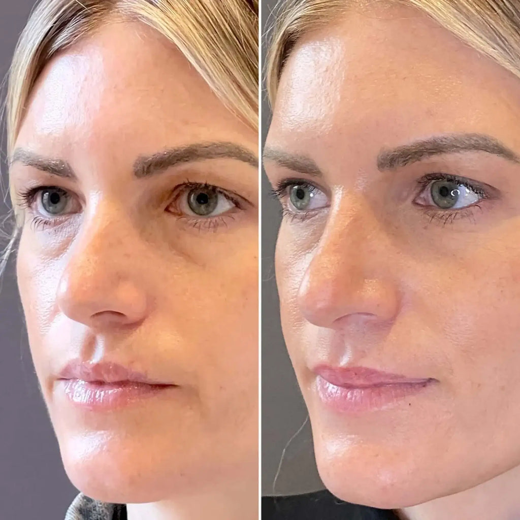 EyeFix: Upper Blepharoplasty – Beauty Fix MedSpa