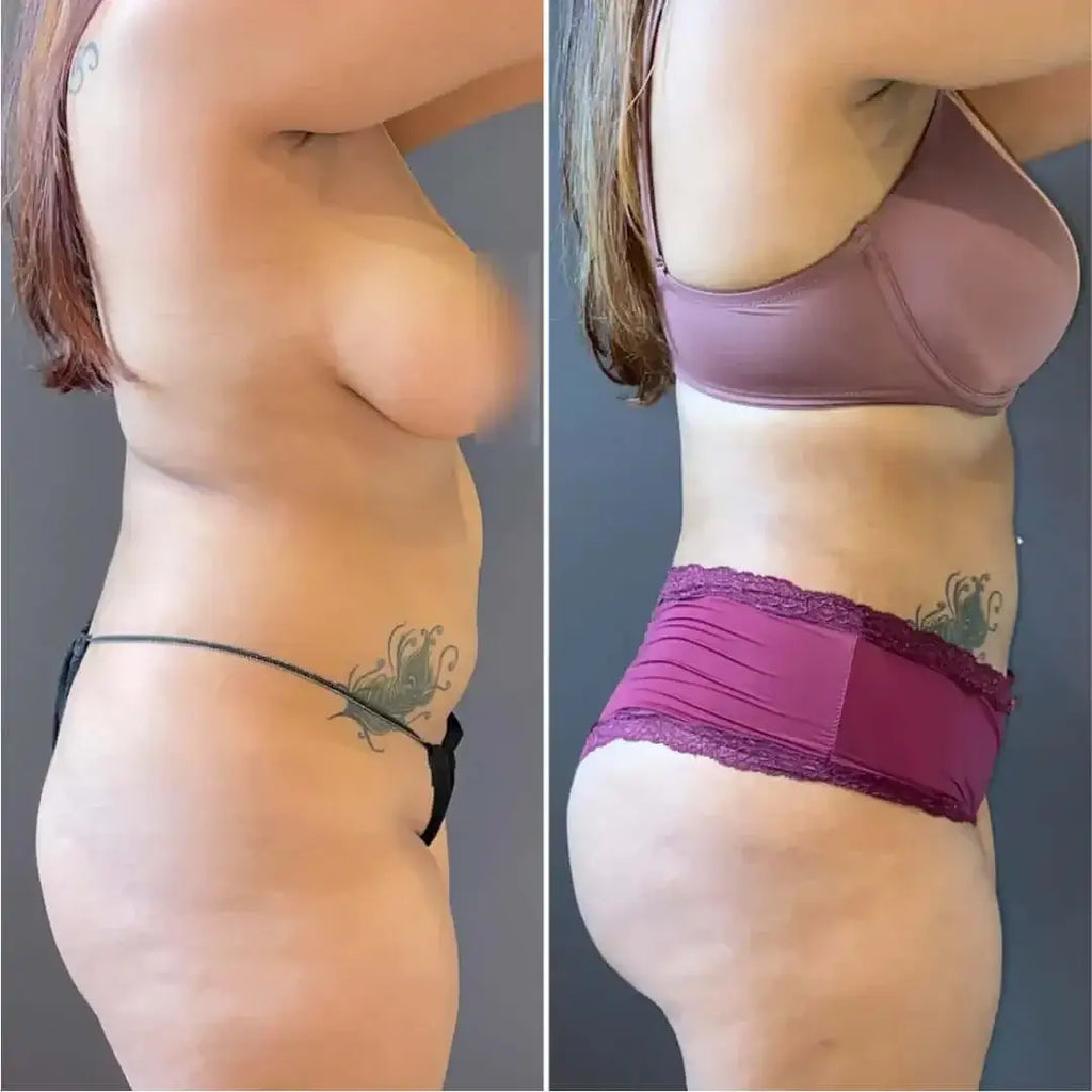 BodyFix: Liposuction – Beauty Fix MedSpa