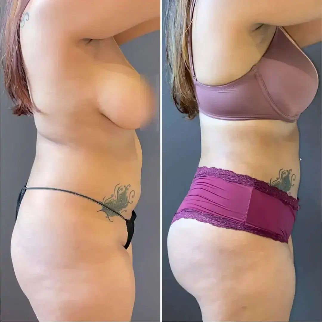 BodyFix: Liposuction – Beauty Fix MedSpa