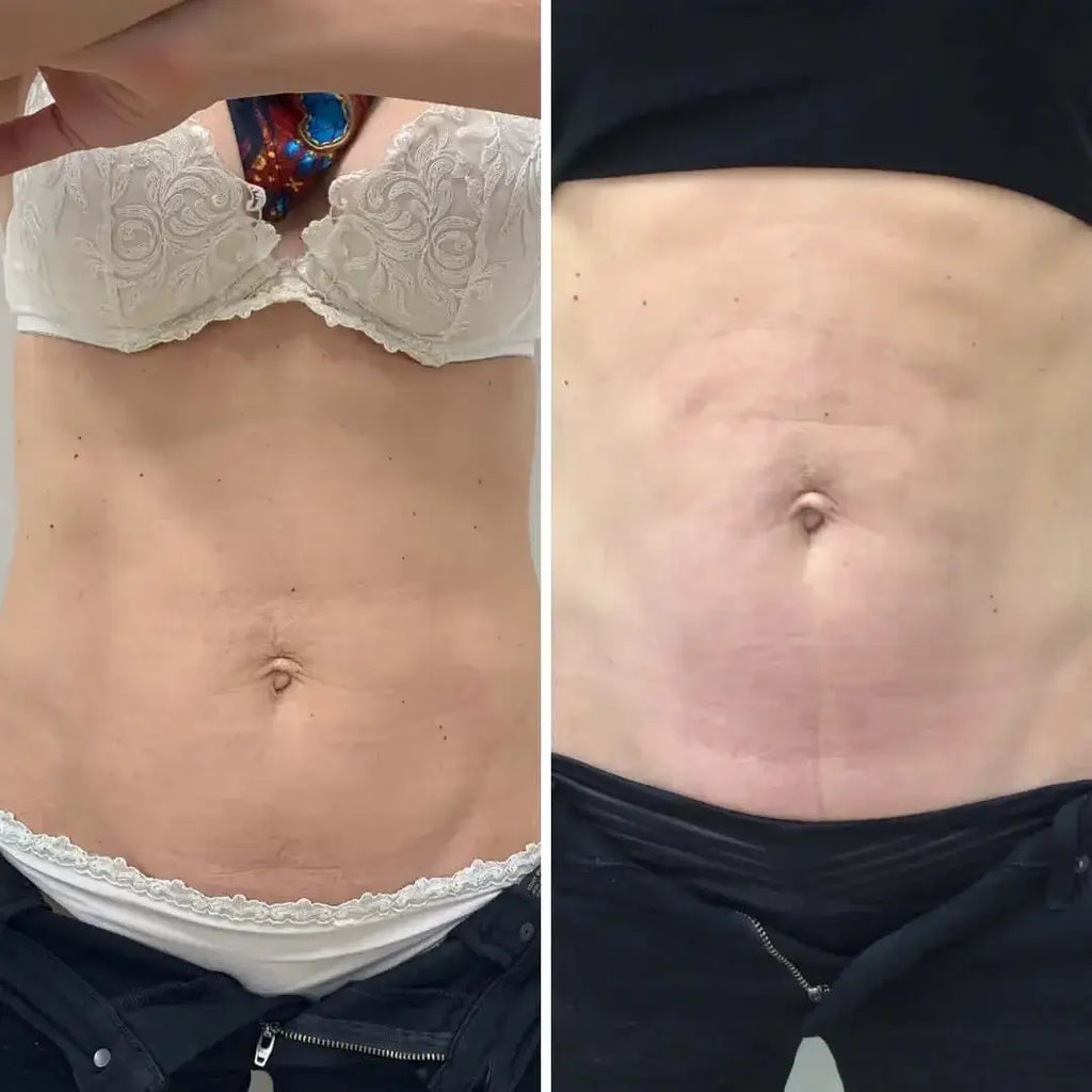 BodyFix: Morpheus8 – Beauty Fix MedSpa