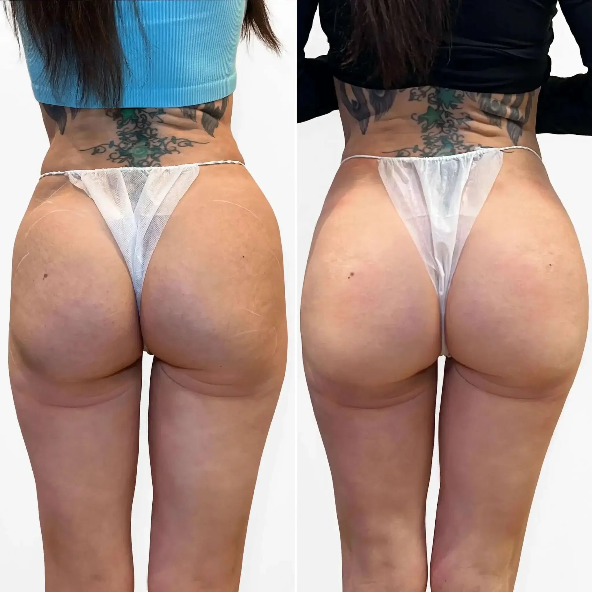 BootyFix: Renuva Butt Lift