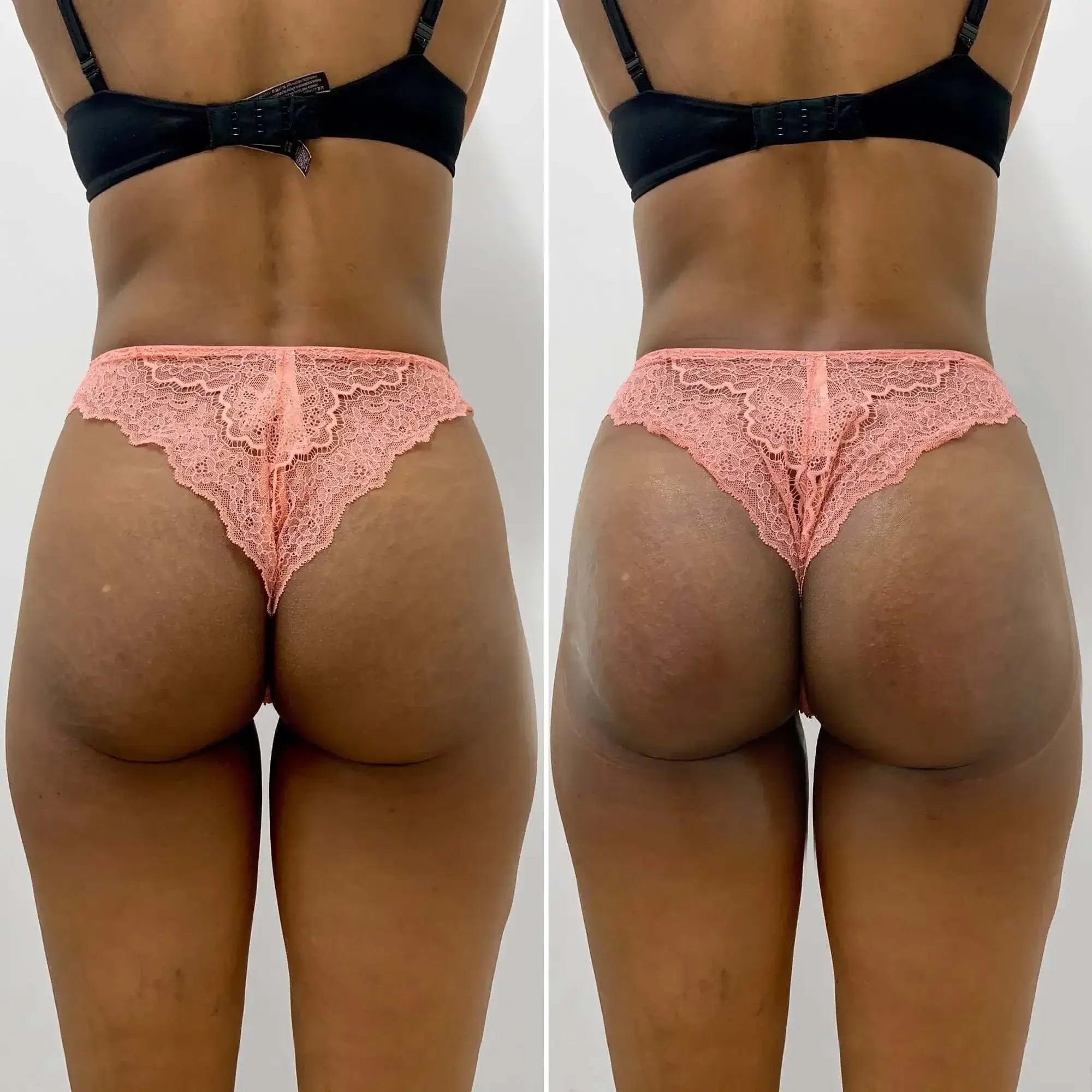 BUTT BUMBUM Buttocks Enhancement Gel - Home kits - SoFlo Medical Center, Healtcare Services