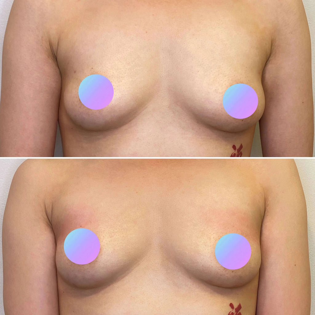 BreastFix: Renuva Breast Lift – Beauty Fix MedSpa