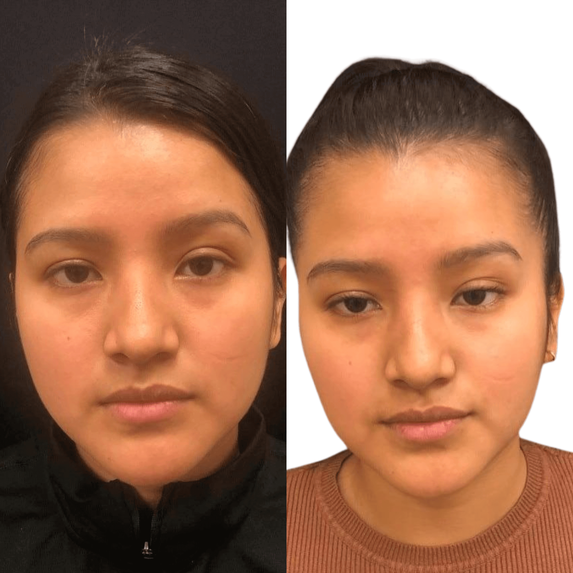 CheekFix: Buccal Fat Reduction – Beauty Fix MedSpa