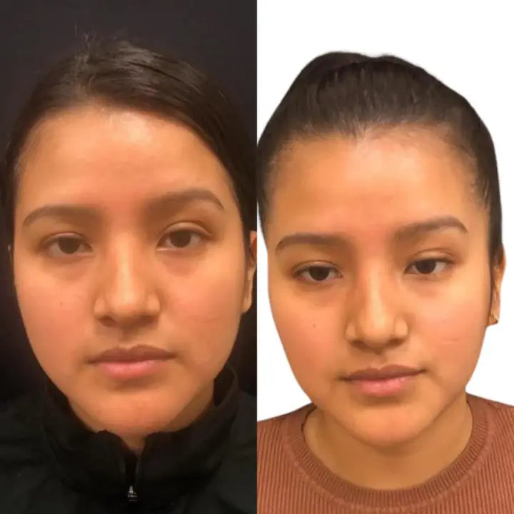 CheekFix: Buccal Fat Reduction – Beauty Fix MedSpa
