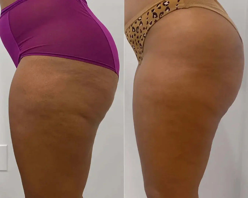CelluliteFix: Venus – Beauty Fix MedSpa