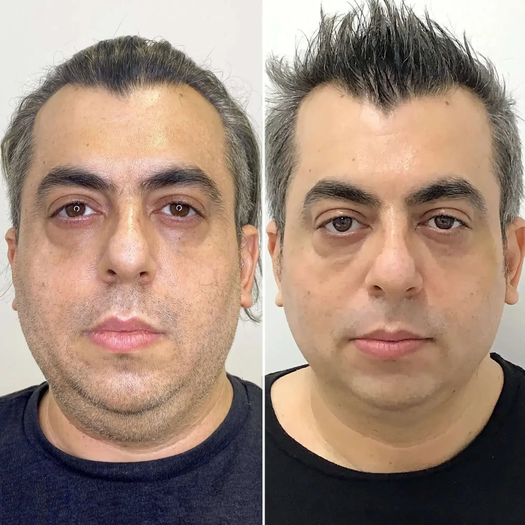 BodyFix: Liposuction – Beauty Fix MedSpa