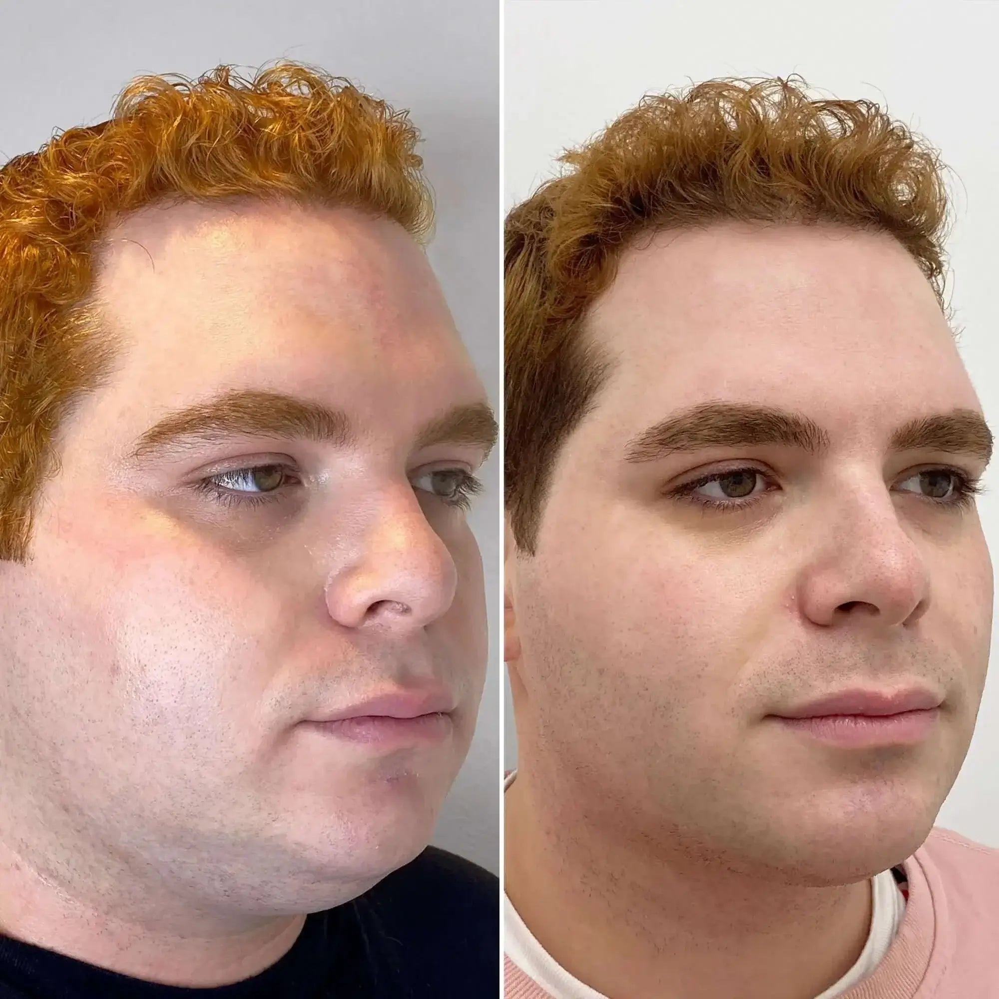 ChinFix: Liposuction – Beauty Fix MedSpa