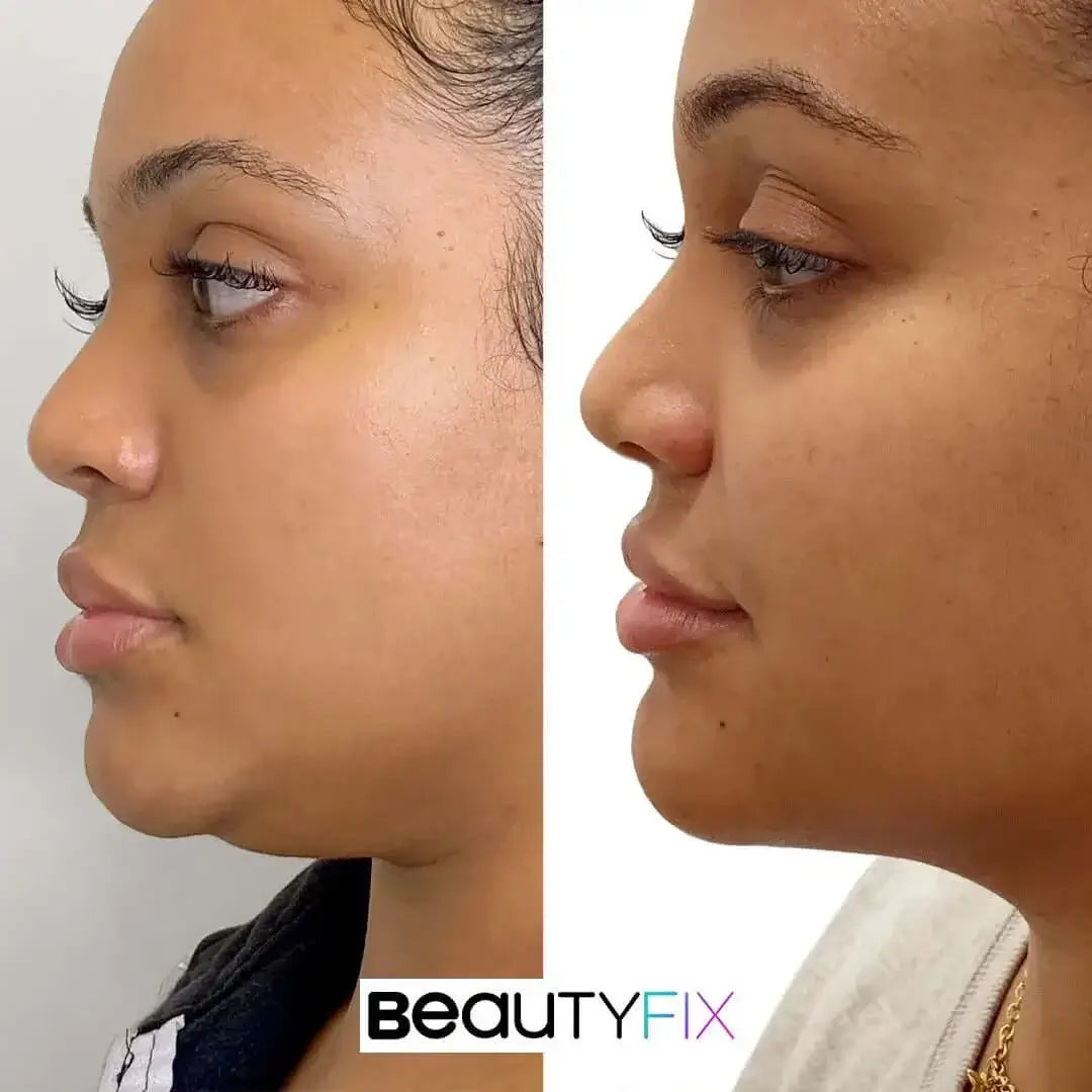 ChinFix: Liposuction – Beauty Fix MedSpa