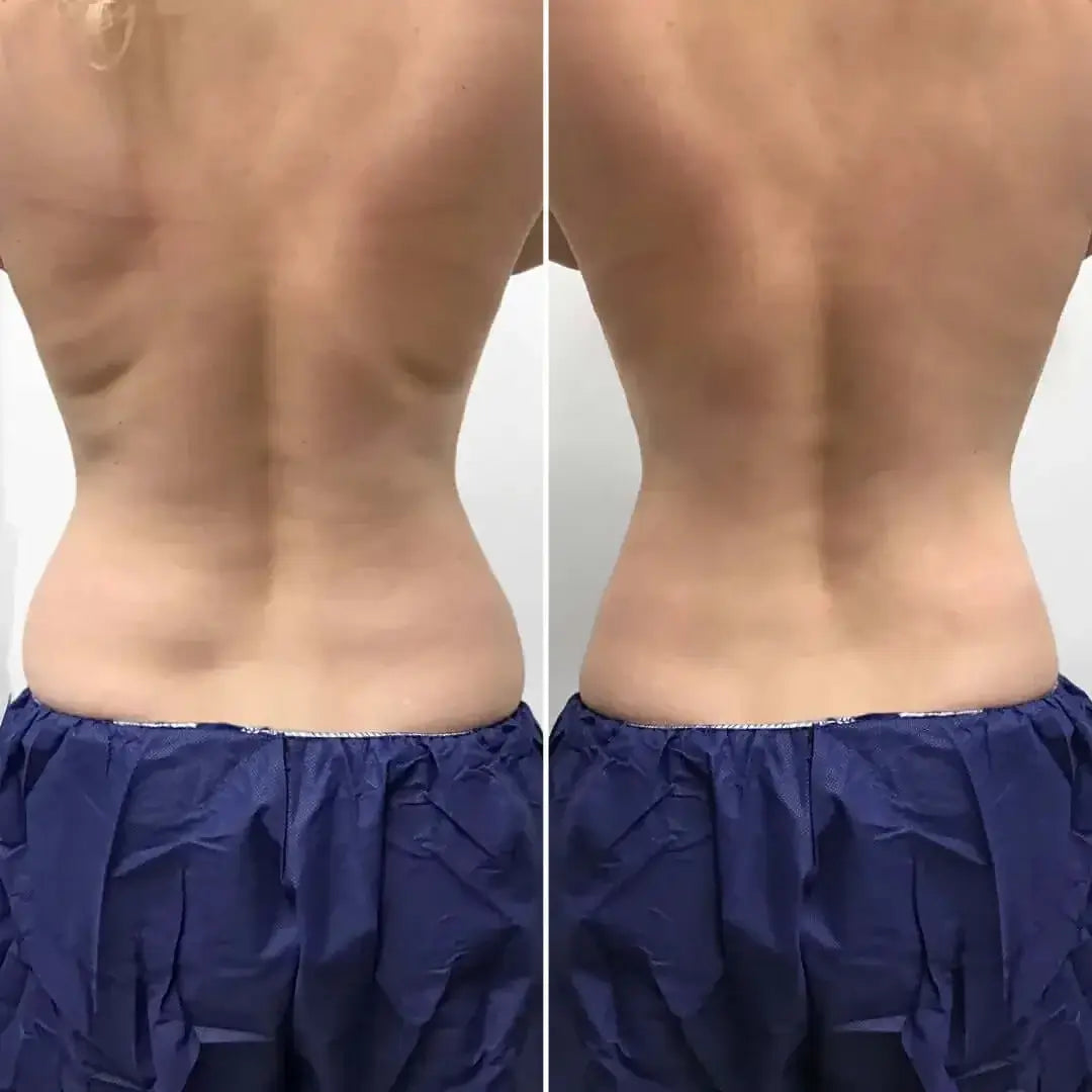 BodyFix: CoolSculpting® Elite – Beauty Fix MedSpa