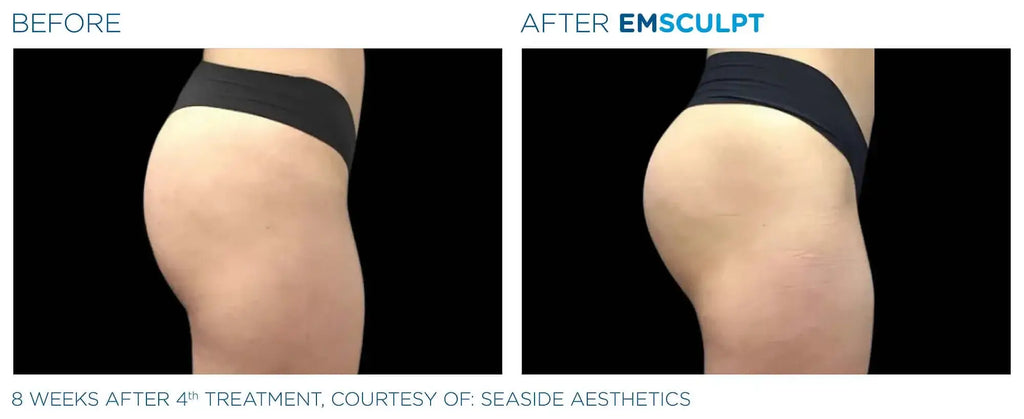BootyFix: EmSculpt Neo – Beauty Fix MedSpa