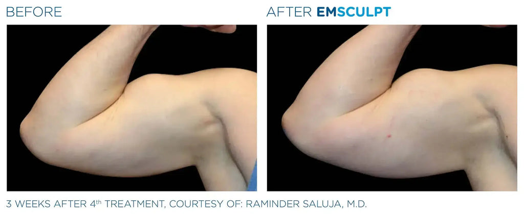 ArmFix: EmSculpt Neo – Beauty Fix MedSpa