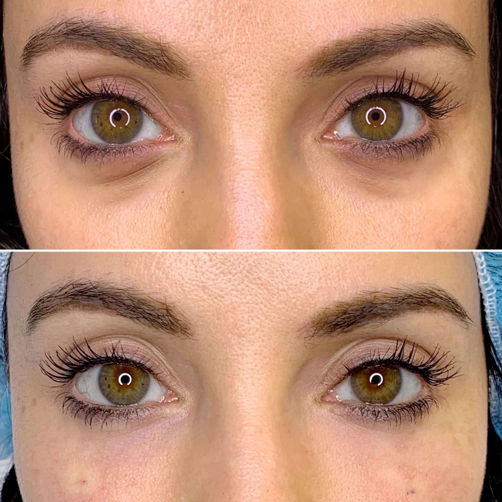 EyeFix: Filler – Beauty Fix MedSpa