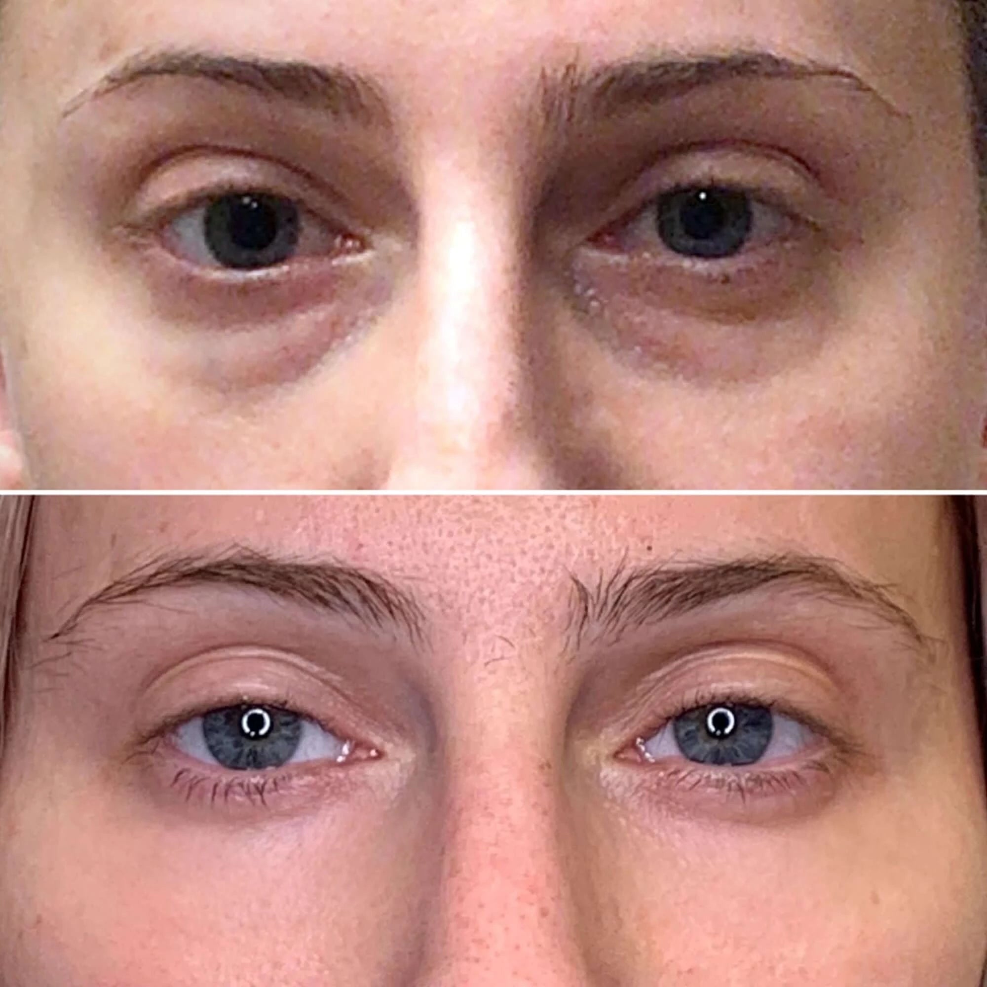 Tear Trough Correction What To Expect With Under Eye Filler